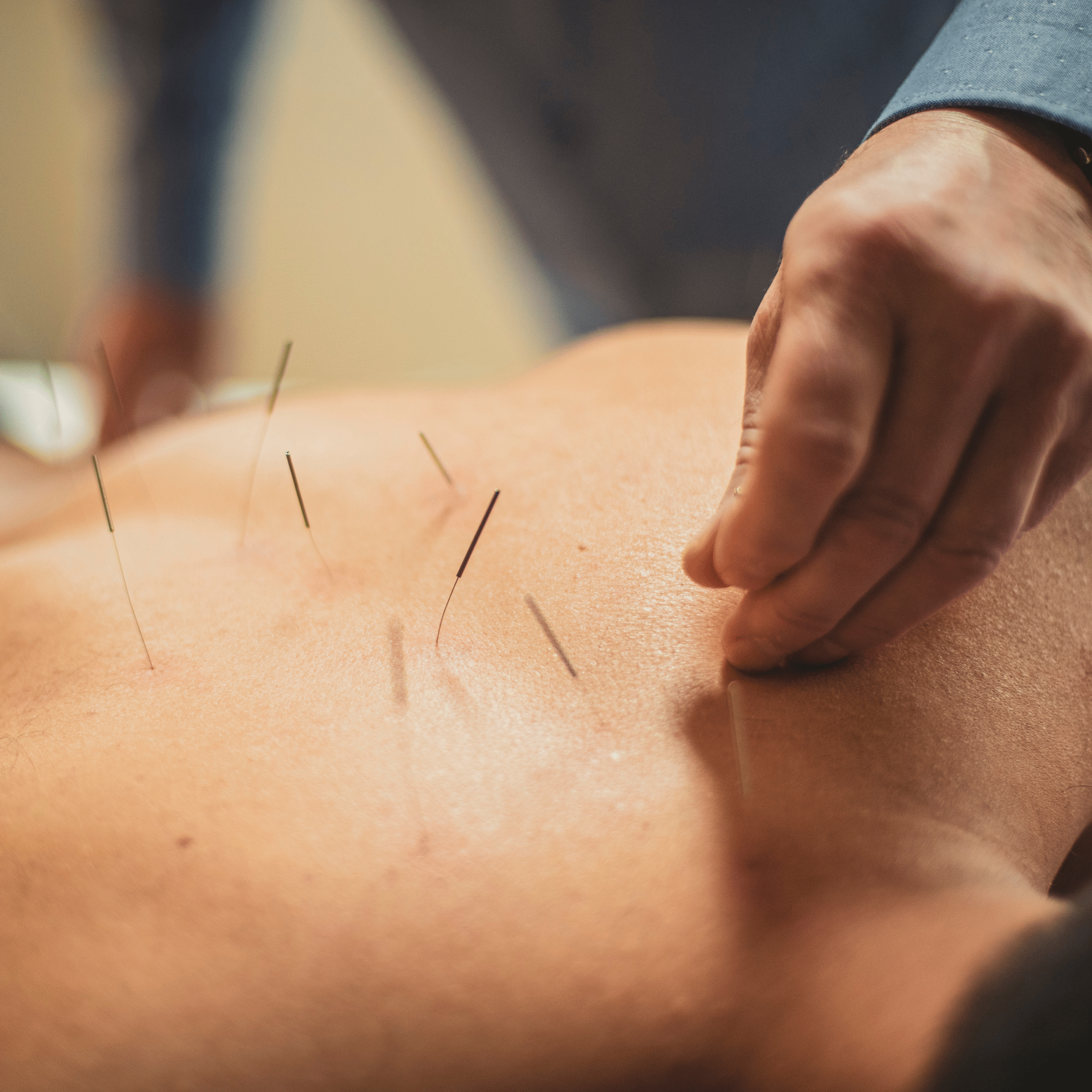 Acupuncture Therapy Scarborough